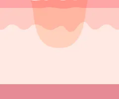 クレーター部分だけに肌再生が起こる