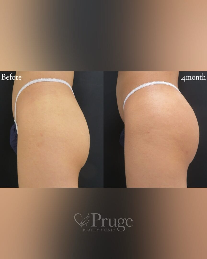 PRP注射によるヒップ形成（アイスプレミアム）