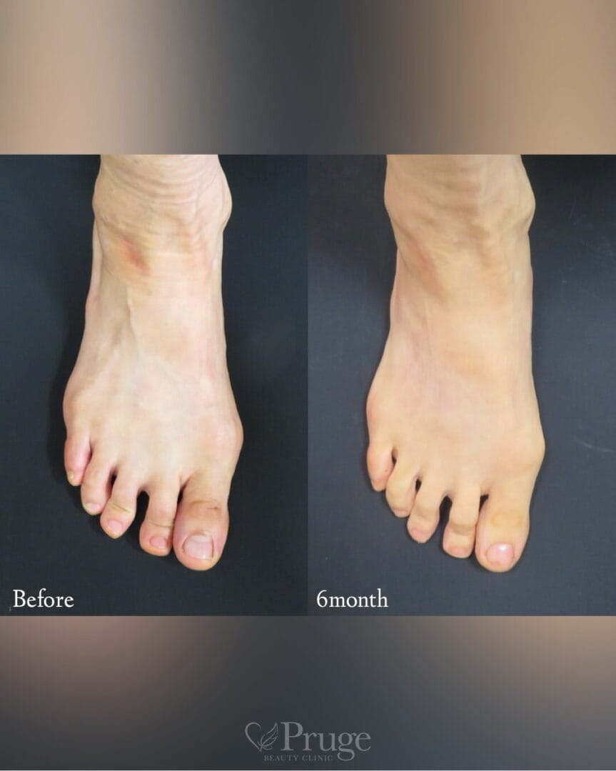 PRP注射（足の甲）