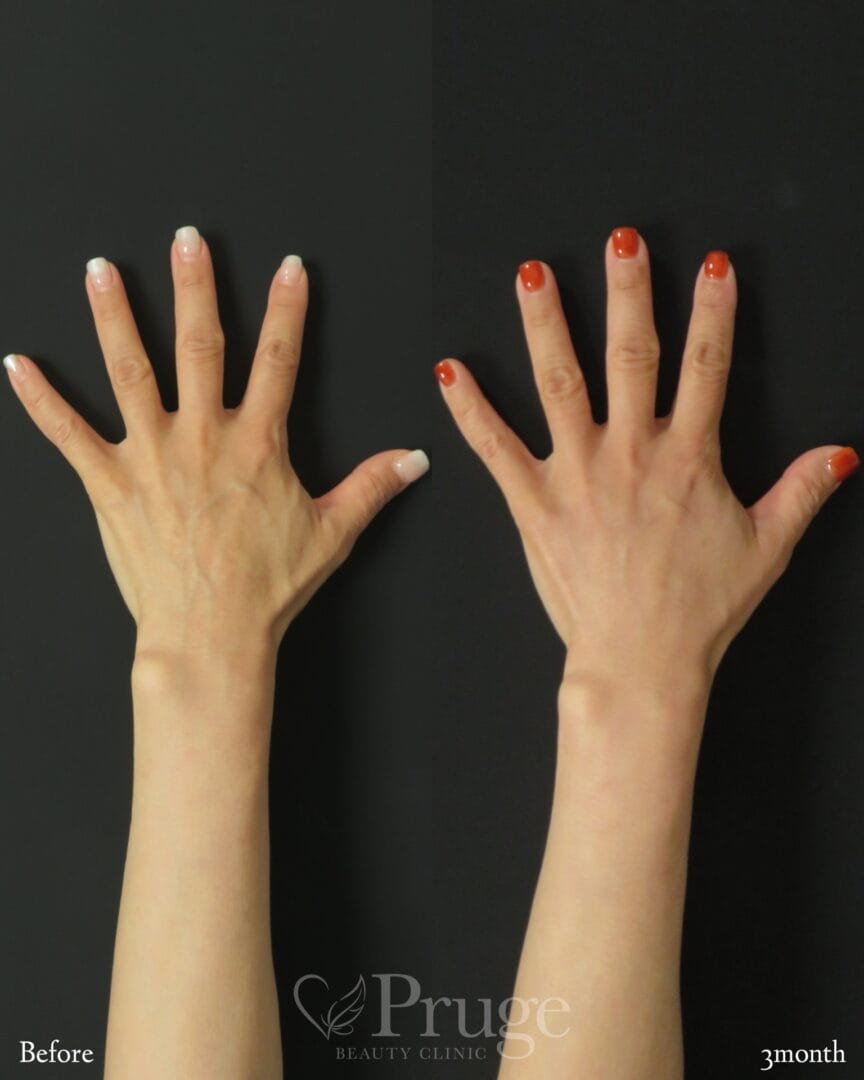 PRP注射(手の甲)