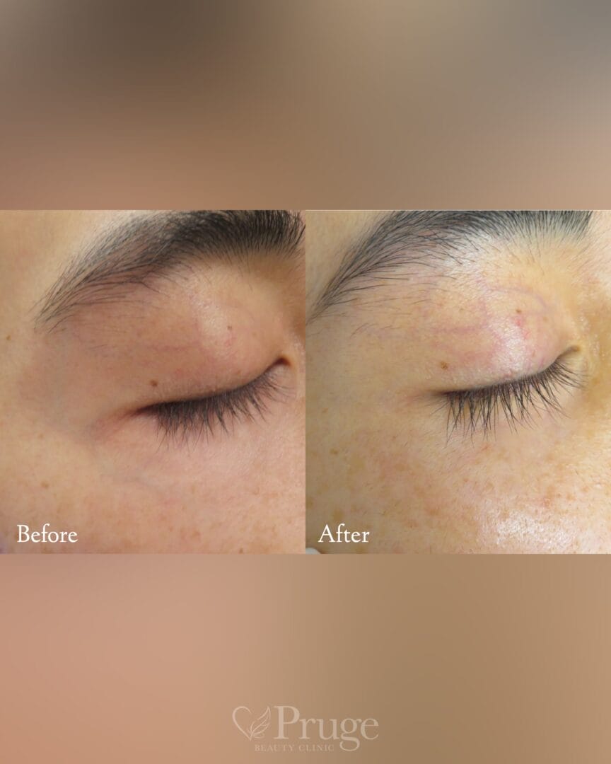 目尻から目の下にかけての血管に対するフェイススクレロセラピー