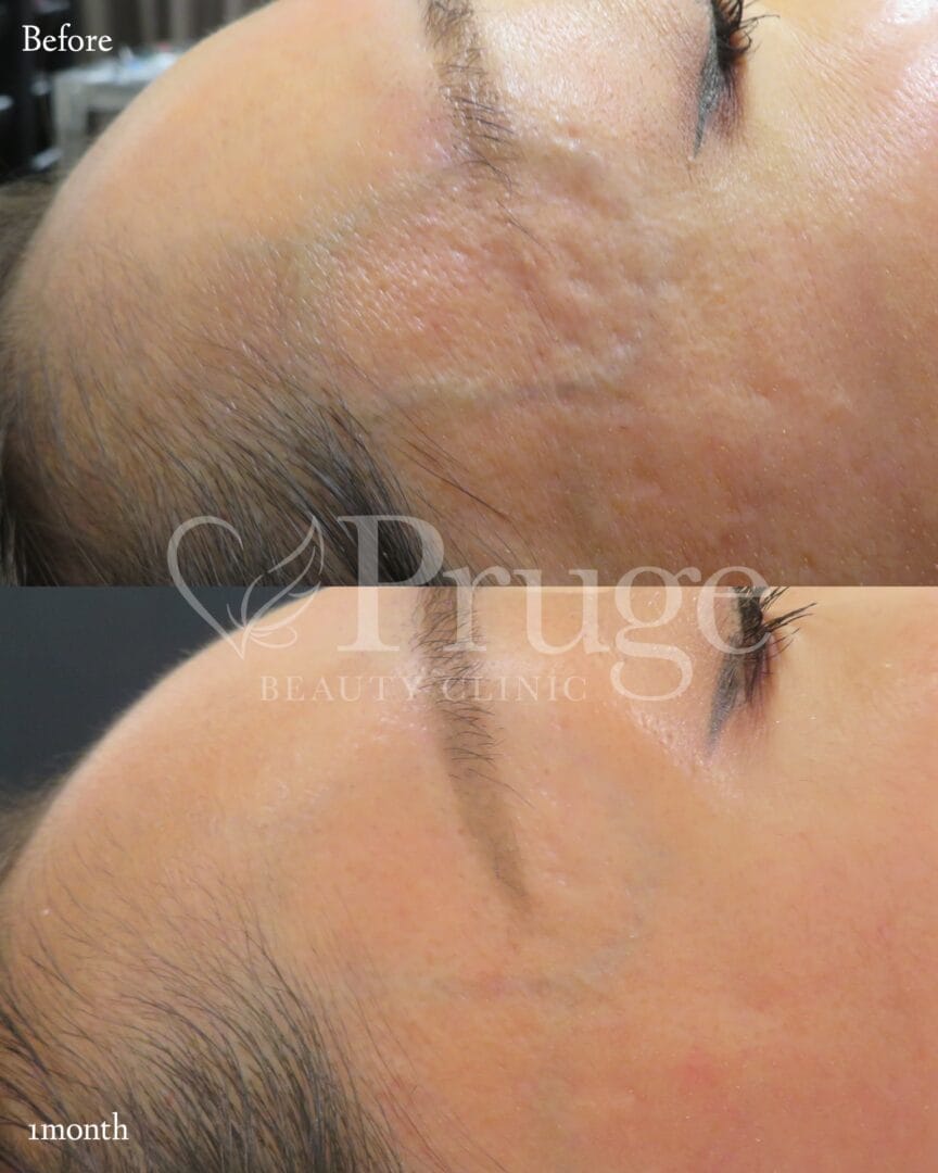 こめかみの血管に対するフェイススクレロセラピー