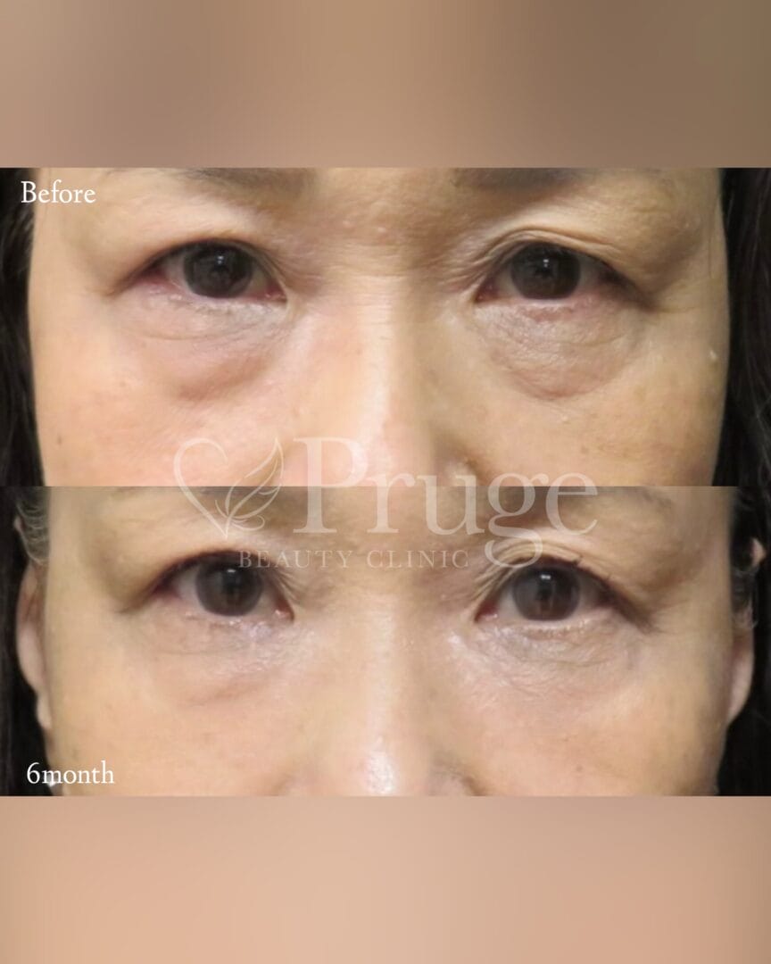 PRP注射（目の下）