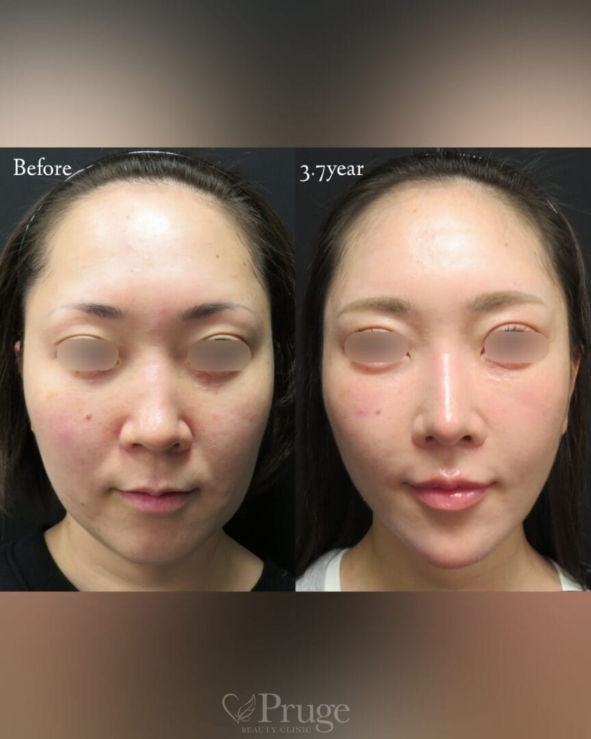 PRP治療の症例写真