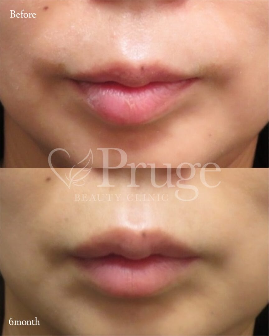 PRP注射(唇)の症例写真