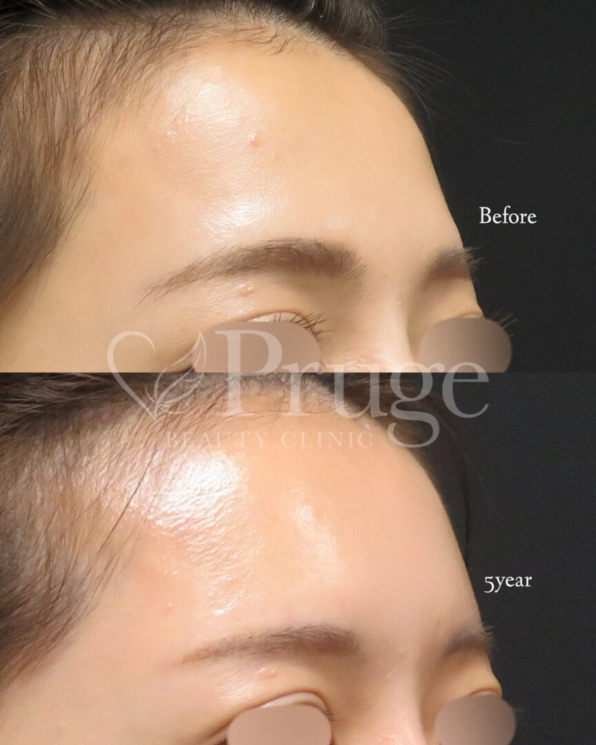 PRP注射（ひたい・こめかみ丸み形成術）の症例写真