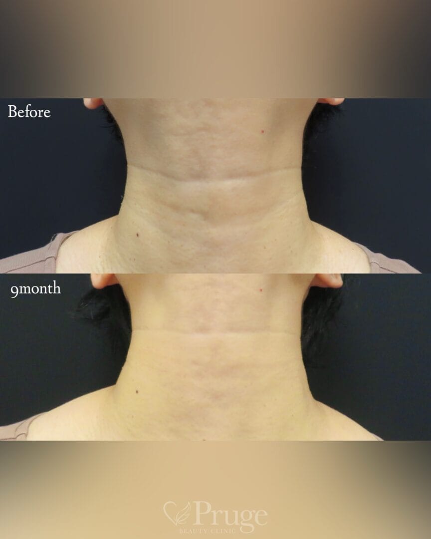 PRP注射(首)の症例写真