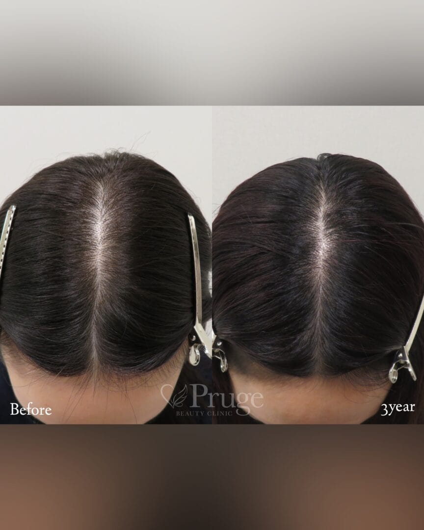 ｐ-Scalp(2回)の症例写真