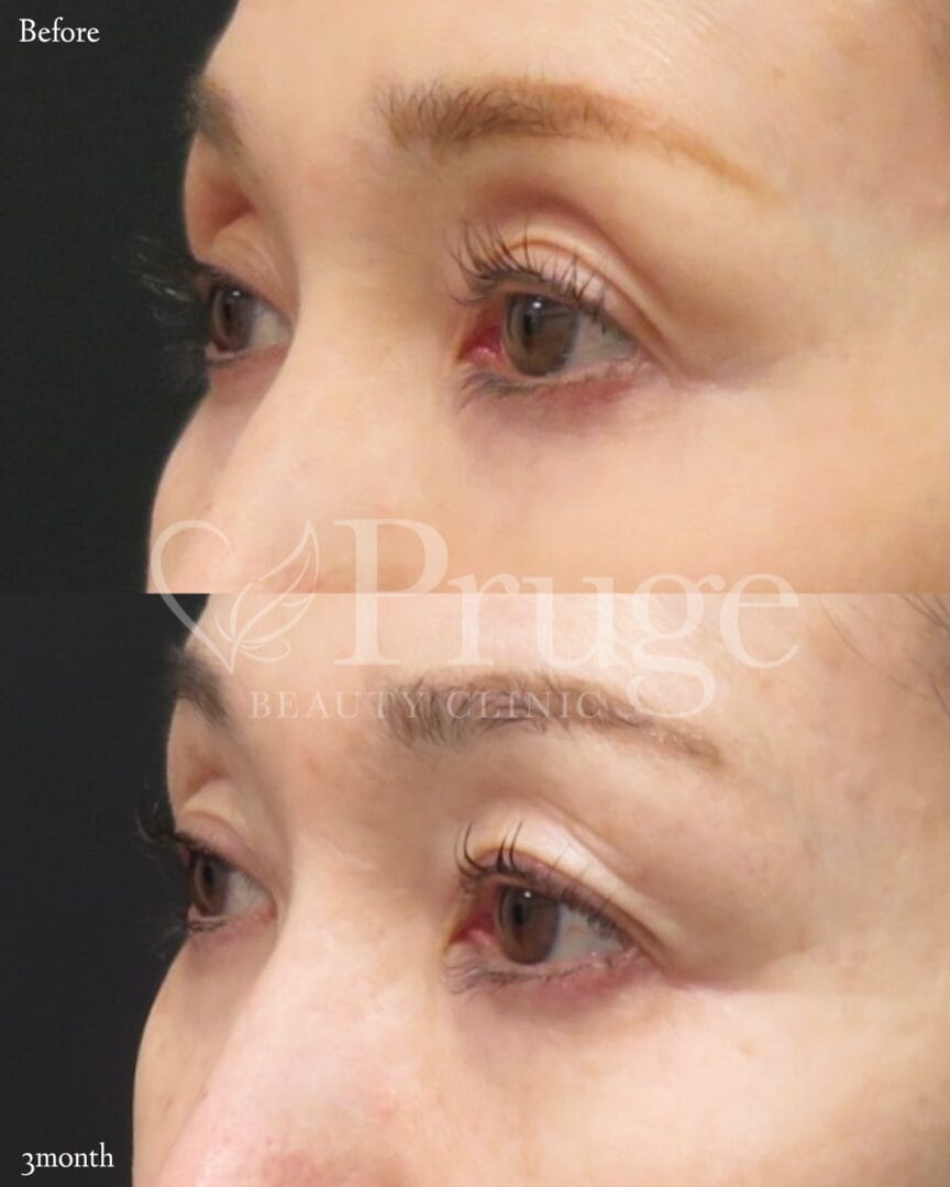 PRP注射(目の上)の症例写真