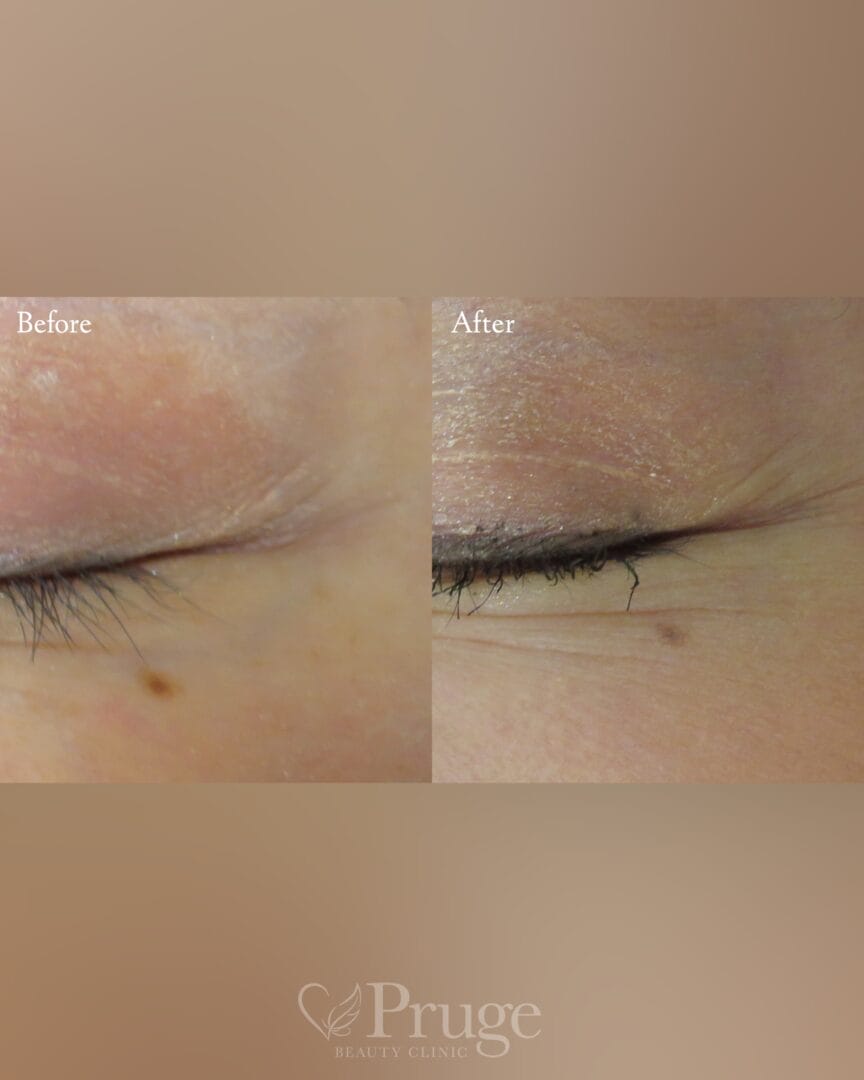 フェイススクレロセラピー(目尻)の症例写真