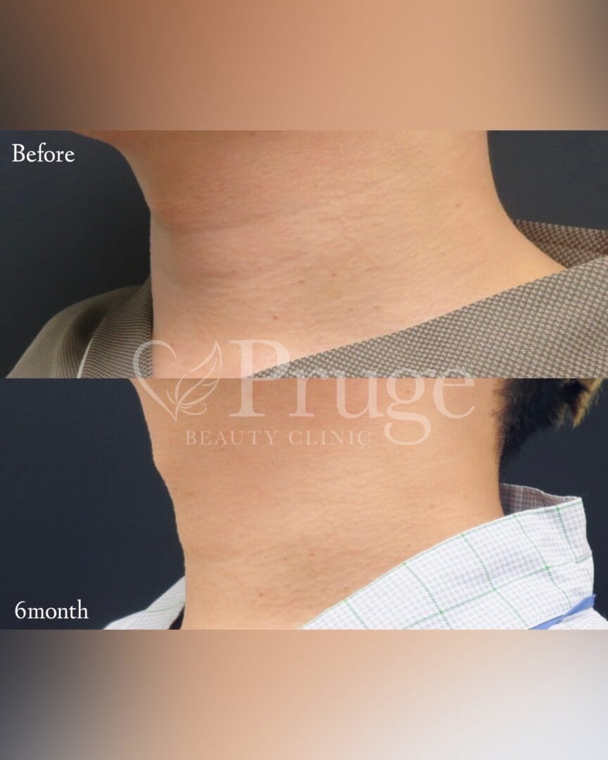 PRP注射(首)の症例写真