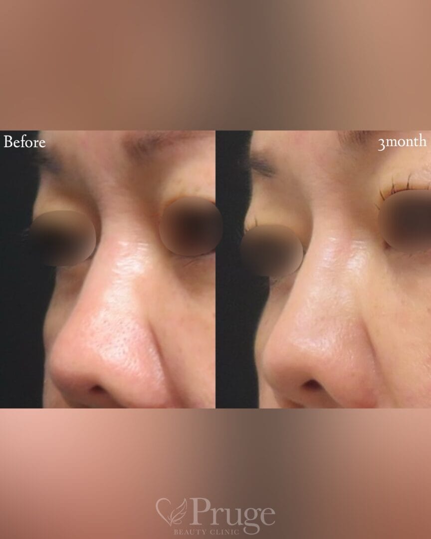 PRP注射（鼻根)の症例写真