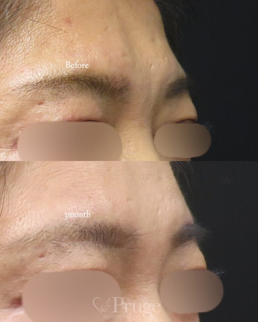 PRP注射（眉間）の症例写真