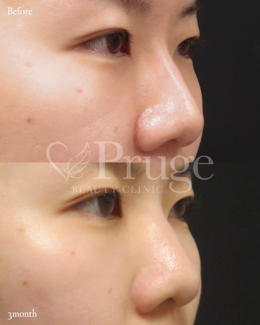 PRP注射(ゴルゴライン)の症例写真