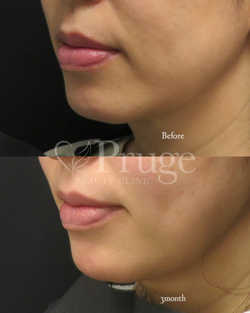 PRP注射（あご）の症例写真