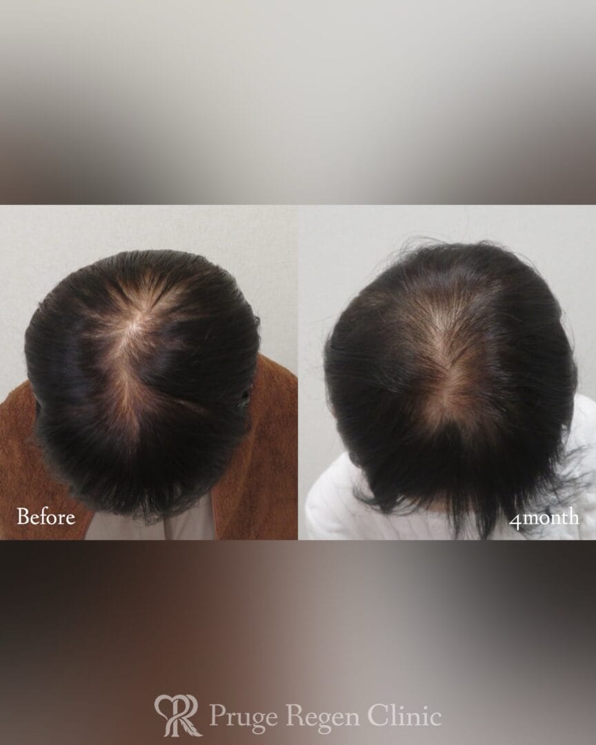 PRP注射（後頭部形成術）の症例写真