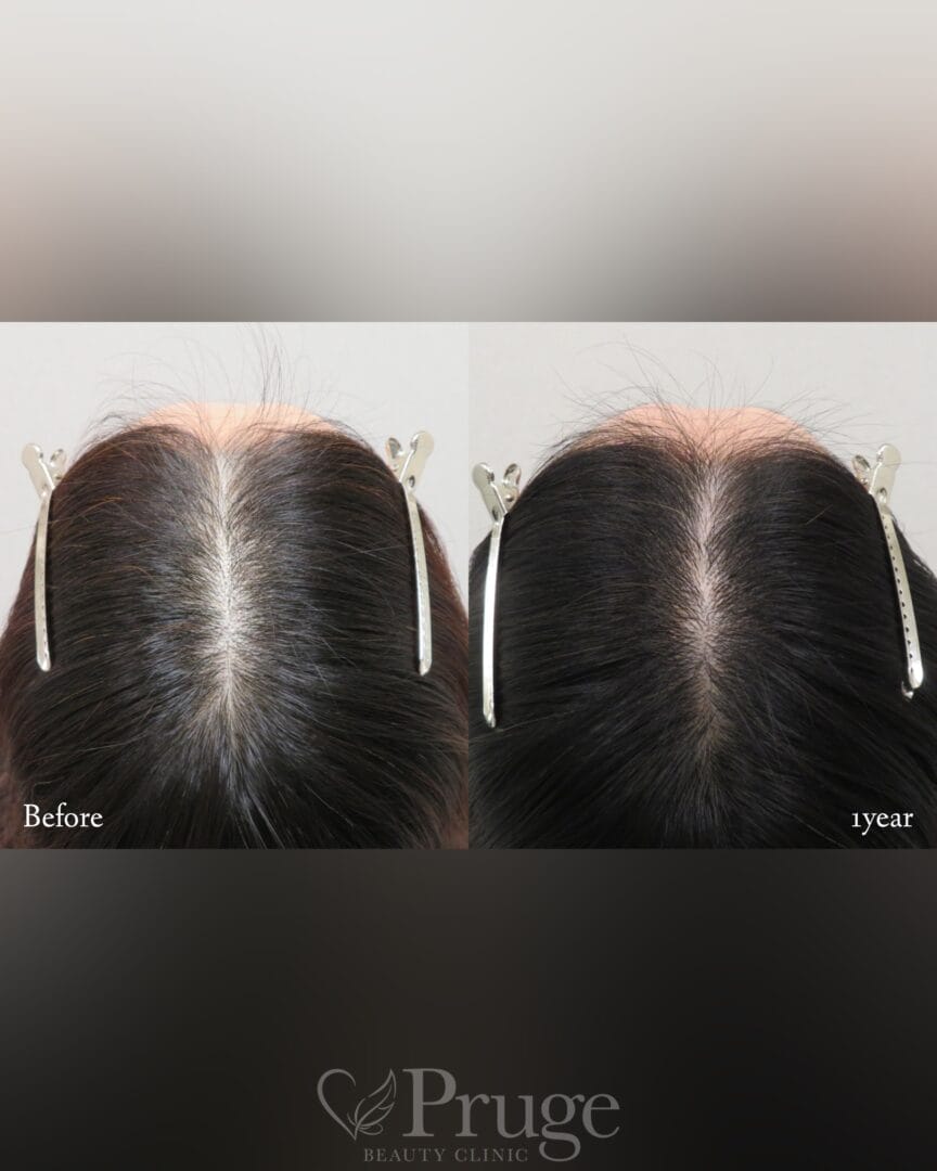 p-Scalp