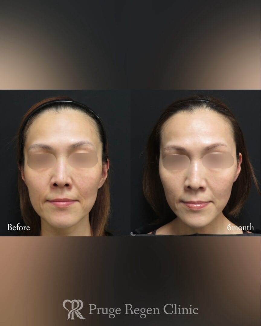 PRPスレッドリフトの症例写真